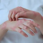 Eczema Explained for Better Skin Care