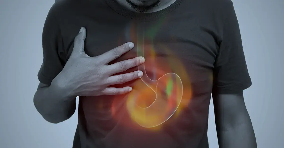 What Is Acid Reflux? A Simple Overview